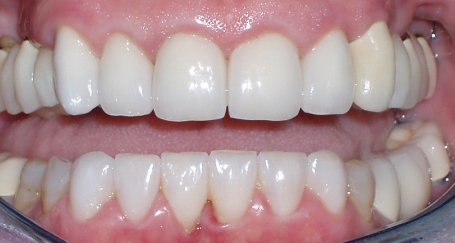 Newly replaced dental restorations