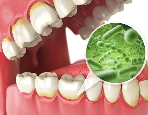 Illustration demonstrating how bacteria penetrate gum tissues