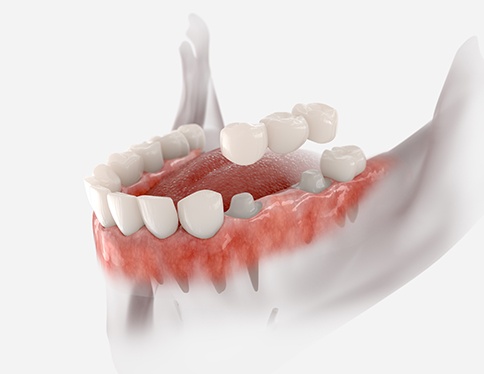 Illustration of dental bridge being placed on teeth