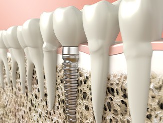 Digital illustration of a dental implant