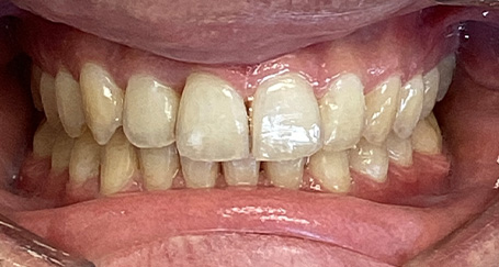 Newly replaced dental restorations