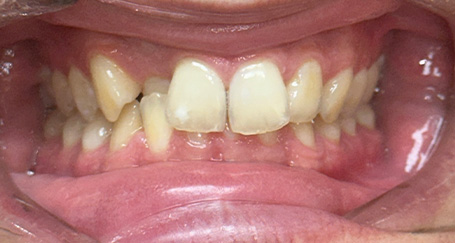 Damaged and unnatural looking dental restorations