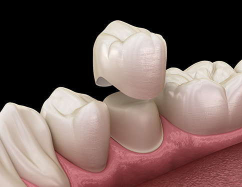 Dental crown being placed on a tooth